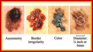 melanoma