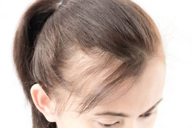 Pcos Hair Pcos Hair Loss Does Polycystic Ovaries Cause Hair Loss Is 