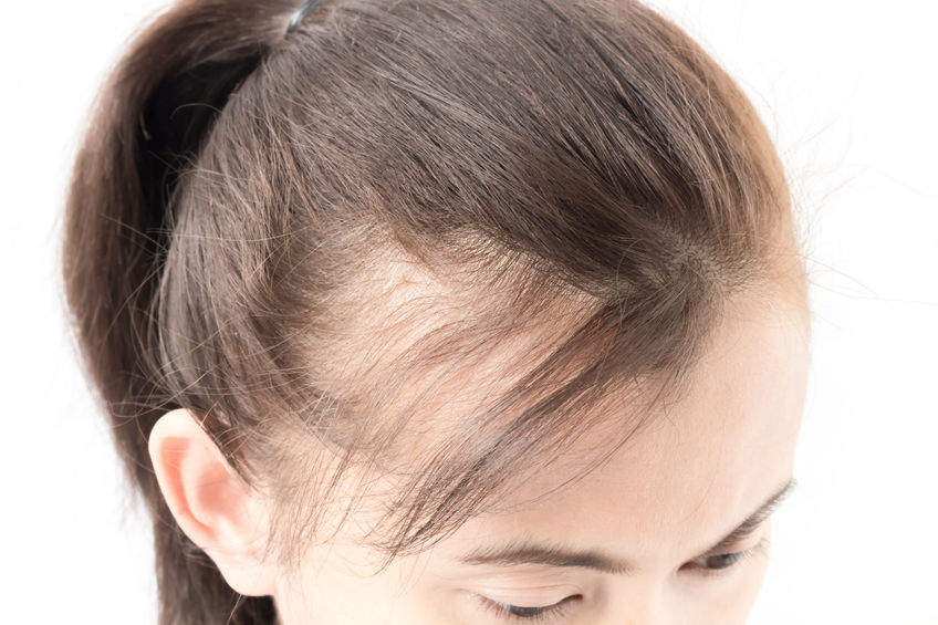How to Treat PCOS-Related Hair Loss (Doctor's Guide) | Clinikally
