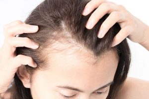 Consideration of Herbal Treatment for Androgenic Hair Loss;