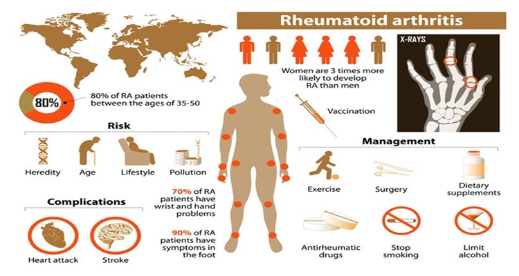 Natural Treatment for Rheumatoid Arthritis