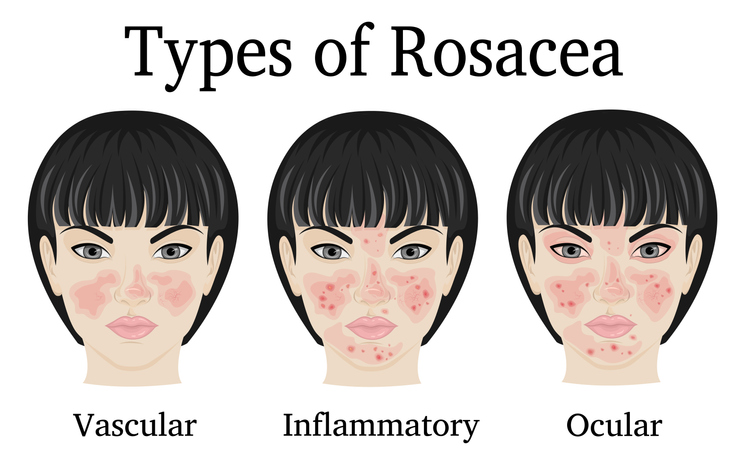 rosacea cheeks treatment