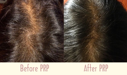 prp treatment for hair loss
